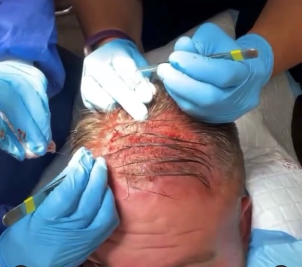 Images UFP Hair Restoration